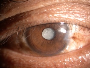 cataract - Copy